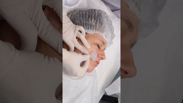 Мезонитевая коррекция орбитальной зоны с помощью нитей Моно