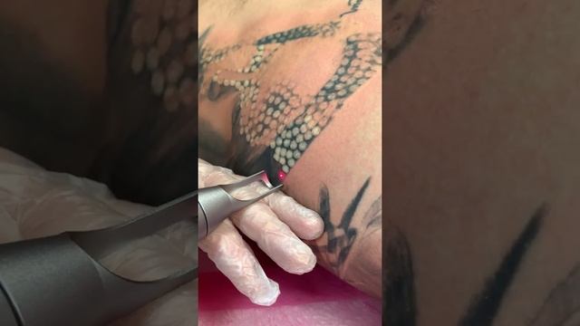 Удаление татуировки лазером