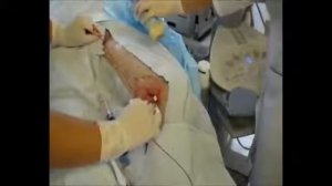 Процедура РЧА учебное видео 1