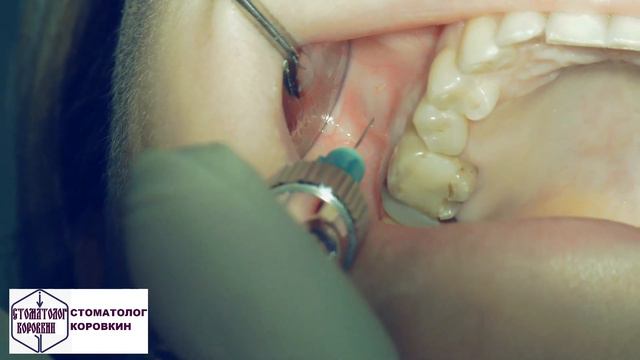 Инфильтрационная анестезия для для лечения 16. смотреть онлайн