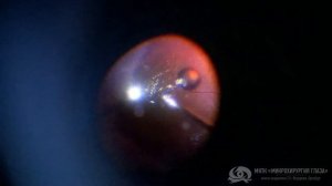 Регматогенная отслойка сетчатки