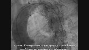 Стентирование аневризмы грудной аорты