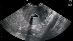 «Эхогистеросальпингоскопия (ЭХО ГСС).