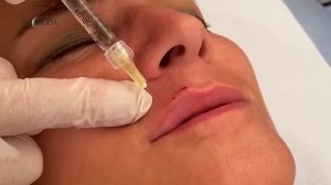 Webinar Lips volume and periorbital enhancement talk ( part 3 )