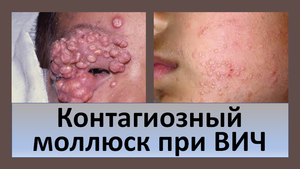 Контагиозный моллюск при ВИЧ