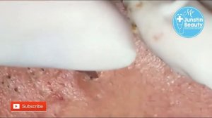 The getting rid of the acne blackheads on forehead - Acne Treatment Vlogs #Ep 41