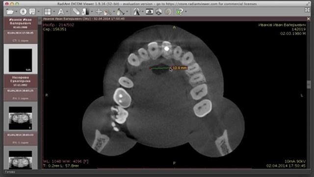 Radiant DICOM viewer для 3D. Знакомлюсь с программой.