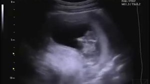 узи Алиски 12 недель