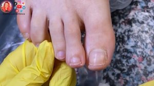 Скручиваются ногти на ногах / Ноготь после хирурга