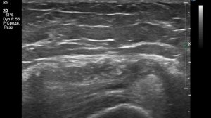 Внутрисуставное введение в коленный сустав под узи контролем , knee injection by  ultrasound contro