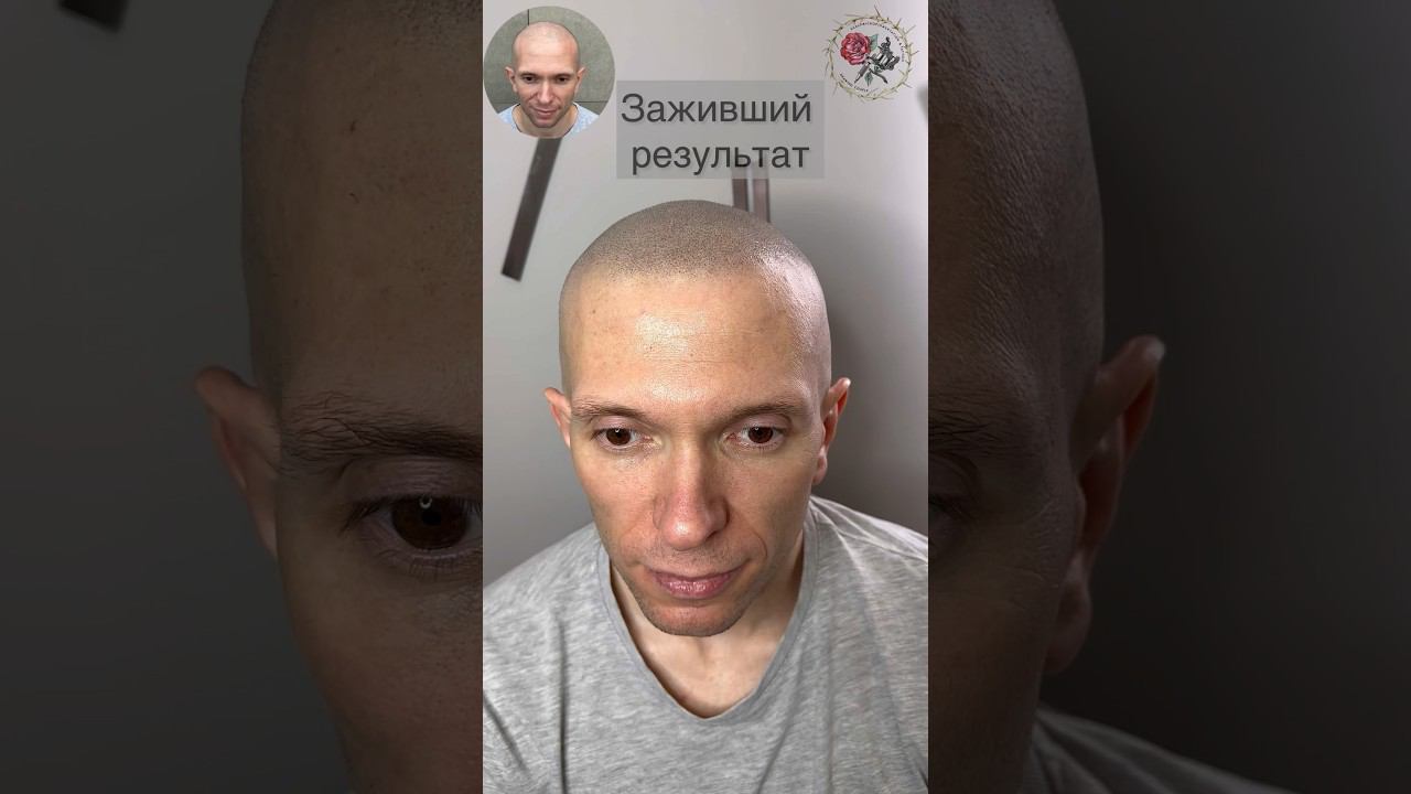 Заживший результат через 7 месяцев! Трихопигментация лучше чем пересадка волос SMP против облысения