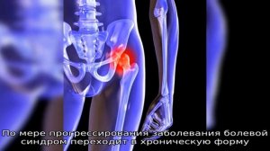 Что такое остеосклероз