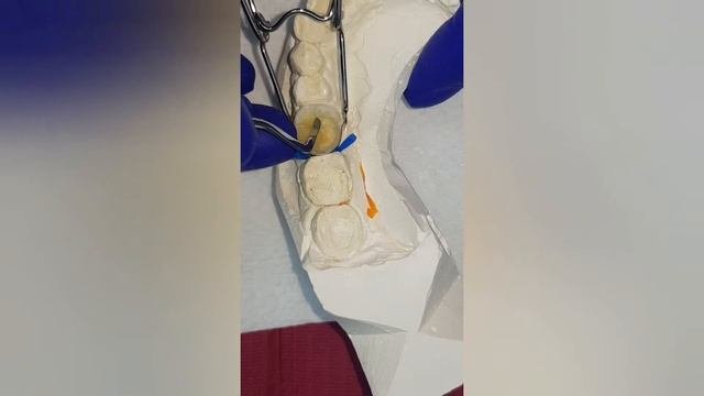 Реставрация жевательного зуба Restoration