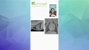 кардиомегалия