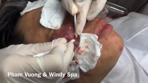 Выдавливание прыщей I Черных точек I Новинка 2021