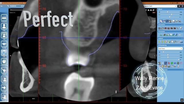 internally irrigated surgical guide смотреть онлайн