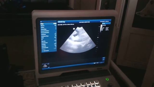 УЗИ брюшной полости смотреть онлайн