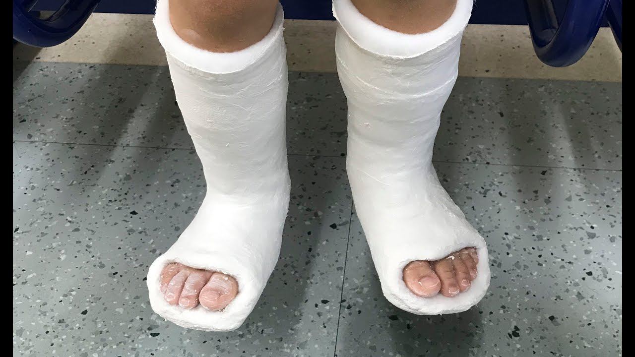 Как происходит гипсование? смотреть онлайн