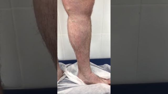 Осмотр флеболога Сардара Алиханова. Флеболог. Москва.