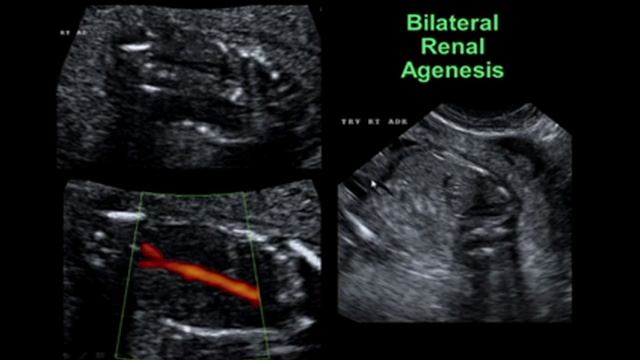 Anomalies of the Fetal Gastrointestinal & Genitourinary Tracts смотреть онлайн