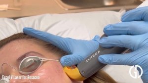 Excel V Laser for Rosacea | Geria Dermatology