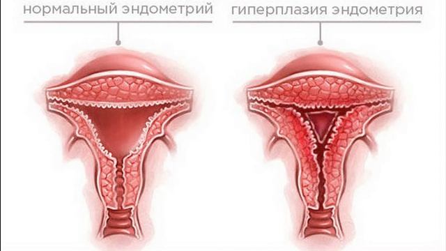 Что такое рак эндометрия (матки)? (подкаст) смотреть онлайн