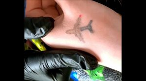 лазерное удаление татуировки