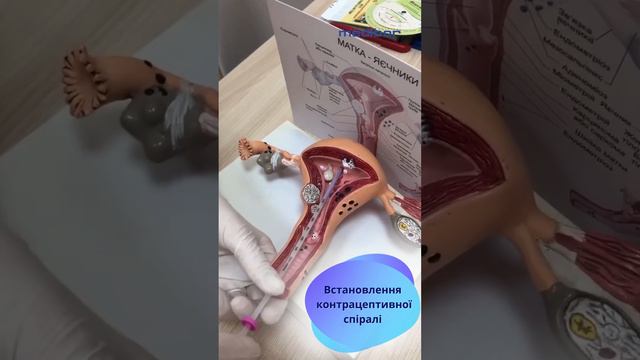 Встановлення контрацептивної спіралі: надійний захист протягом тривалого часу смотреть онлайн
