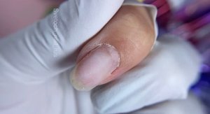 Отслойка у кутикулы