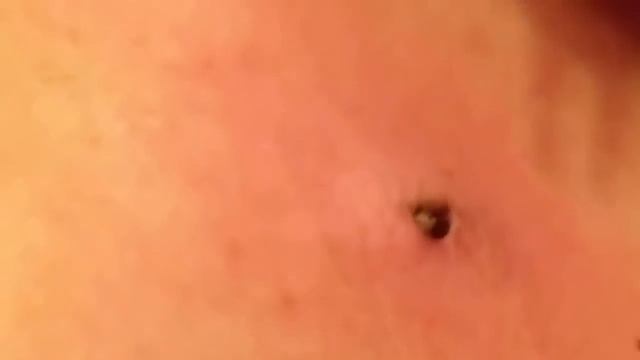 Удаление угрей 25 лет смотреть онлайн