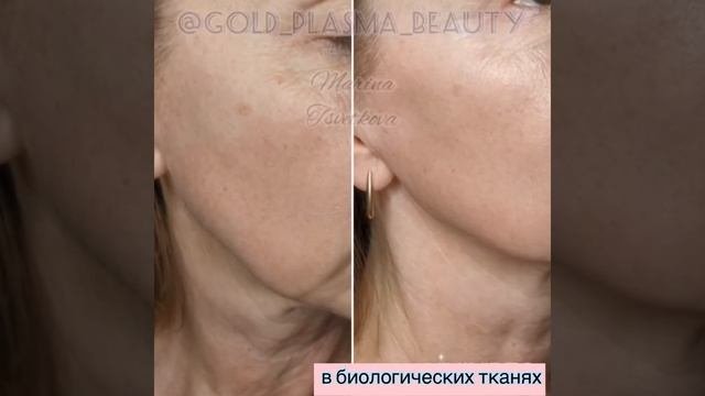Холодная Плазма- молодость и красота кожи без инъекций и скальпеля!