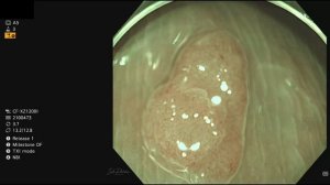 Optical diagnosis: tubular adenoma with LGD