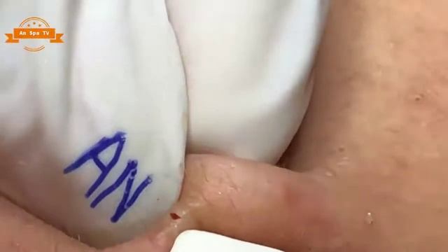 Удаление прыщей с носа и щек Spa G #91