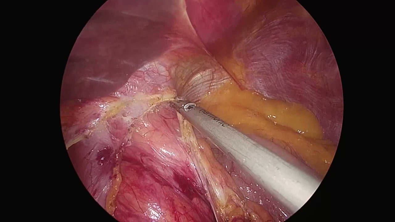 Грыжа пищеводного отверстия диафрагмы Hiatal hernia mesh suture repair смотреть онлайн