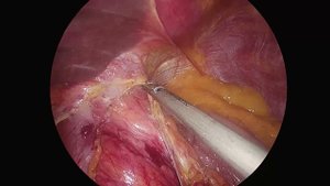 Грыжа пищеводного отверстия диафрагмы Hiatal hernia mesh suture repair