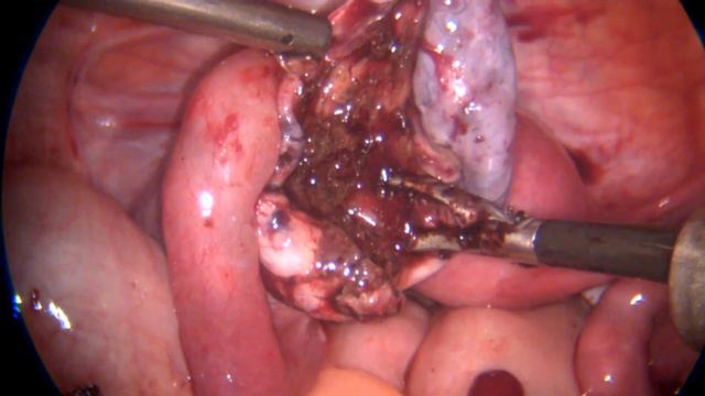 Апоплексия разрыв яичника. Laparoscopic management of bleeding due to apoplexy of the left ovary