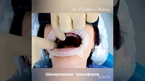 Шинирование трансферов перед снятием слепков(протезирование на имплантатах)