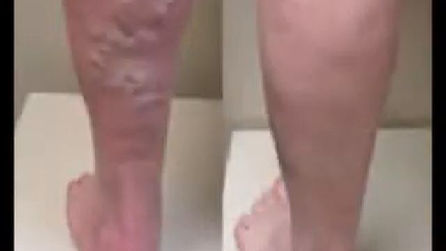 Проведение склеротерапии смотреть онлайн