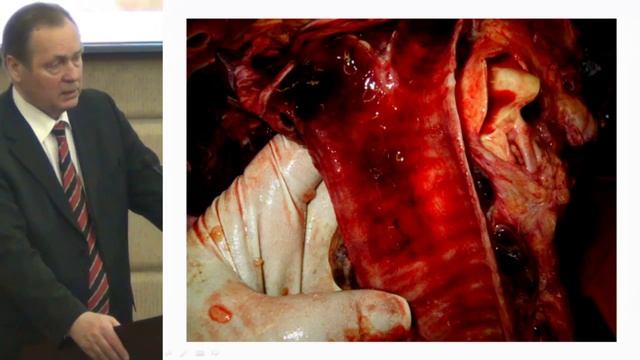 Пневмония как глобальная проблема в современном мире смотреть онлайн