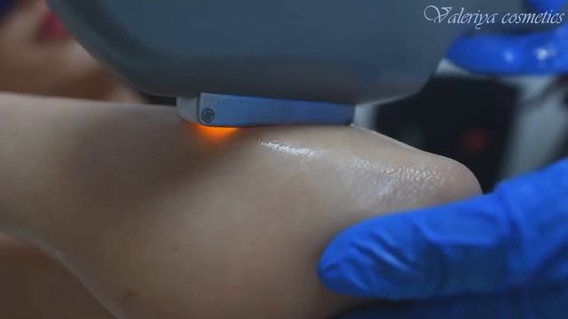 הסרת שיער בלייזר בכפר סבא ולריה קוסמטיקס смотреть онлайн
