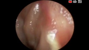 Хронический #тонзиллит, камень #миндалины, диагностика лечение #ЛОР врач КЛИНИКА ОБРАЗЦОВА