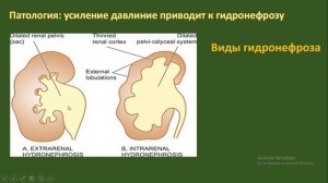 гидронефроз (определение, этиология и причины, патология, диагностика, клиника, виды, лечение)