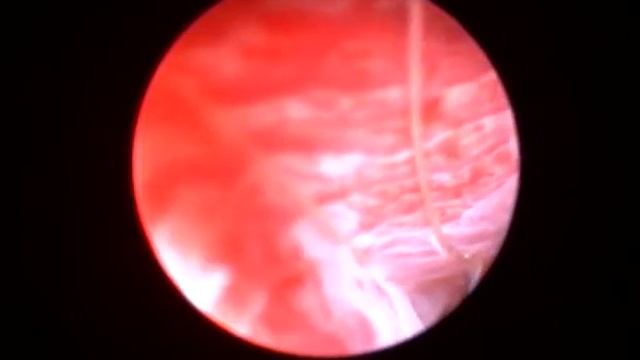 Нитка в носу у кошки, удаление санацией под видеоконтролем смотреть онлайн