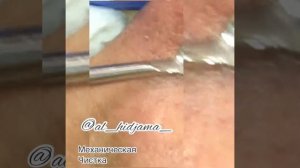Механическая чистка лица очень грязное лицо