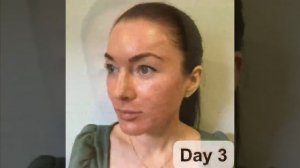 ВСЯ ПРАВДА ПРО ЛАЗЕРНУЮ ШЛИФОВКУ ЛИЦА! ПЕРИОД РЕАБИЛИТАЦИИ