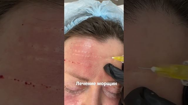 Бланширование, часто, единственный способ убрать морщины