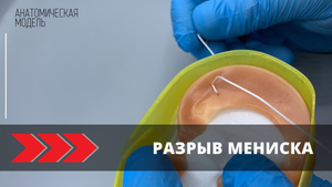 Разрыв мениска