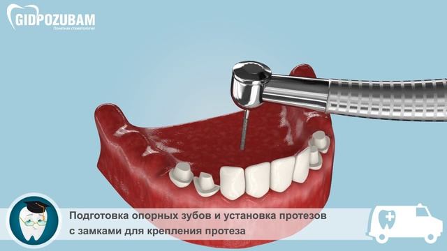 Бюгельные протезы: бюгельный протез на аттачментах или замках