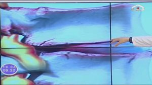 Спондилоартроз - здоровый  позвоночник
