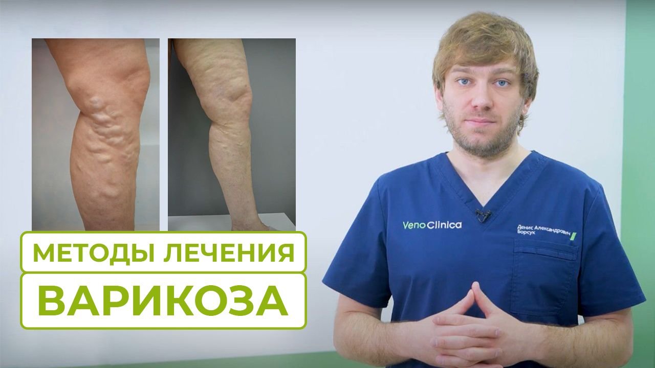Какие бывают методы лечения варикоза